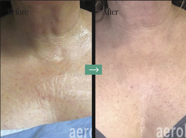 Aerolase Laser Before and After Pictures Charleston County, SC
